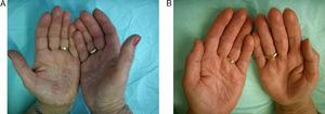 A, Patient with allergic eczema of the hands before treatment with oral alitretinoin. B, Clear hands after a month of treatment.