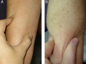 Photograph of the forearm. A, Pinching the skin is difficult due to induration. B, There is a decrease in induration after 12 months of treatment.