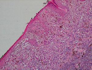 Epidermal effacement overlying malignant melanoma (hematoxylin-eosin, original magnification ×100).