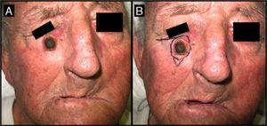 Seventy-one-year-old man with keratoacanthoma on his right cheek (patient 6, Table 2). A, Tumor with a diameter of 2.3cm at the baseline visit. B, Tumor measuring 2.8cm (not treated with intralesional methotrexate) at the time of surgery, 1 month later. An advancement flap was required to repair the surgical defect.