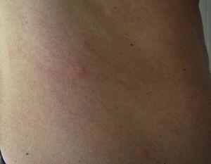 Papular dermatitis with scratch lesions and secondary eczematization on the side of a 25-year-old man.