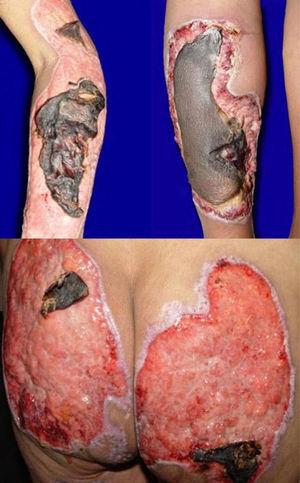 Photograph at presentation. Ulcers with a purulent exudate and covered with necrotic slough.