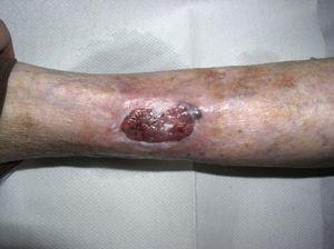 Ulcerated tumor lesion that has become a chronic ulcer, corresponding to basal cell carcinoma.