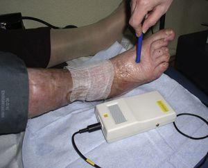 Measurement of ankle-brachial index with handheld Doppler device.