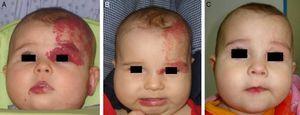 A, Segmental hemangioma in a 3-month old. B, Marked response after 3 months of treatment with propranolol (2mg/kg/d). C, At 9 months, when treatment ended, the hemangioma had practically disappeared and there were no sequelae.