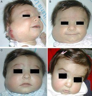 A, A 6-month-old girl with a parotid hemangioma. B-D, The response to propranolol (2mg/kg/d) was rapid after 2, 3, and 5 months, respectively.