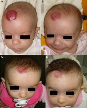 A, A 7-month-old boy with a scalp hemangioma. B and C, After propranolol treatment for 2 and 4 months (2mg/kg/d) improvement was substantial and included flattening of the lesion. D, The hemangioma did not fully disappear. Telangiectasis often persists and can later be removed by pulsed dye laser.