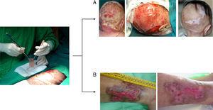 Clinical application of tissue-engineered skin equivalents for permanent regeneration in the treatment of (A) necrotizing fasciitis (images courtesy of Dr. Enriquez de Salamanca) and (B) for the temporary coverage of chronic ulcers.