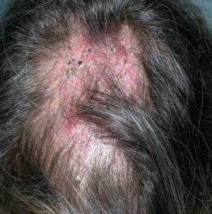 Tinea Capitis in Elderly Women: A Report of 4 Cases | Actas Dermo ...