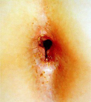 Recent anal sexual abuse. The tear shows the violence of the act. (Photograph courtesy of Jordi Pou).