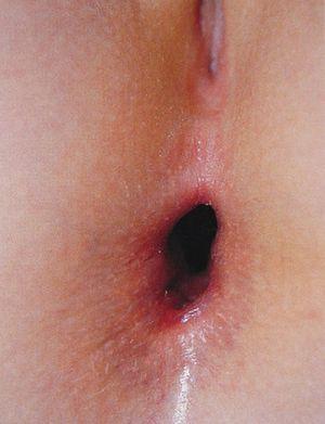 Sexual abuse is often chronic in nature. Anal sphincter dilatation should raise suspicion of abuse. (Photograph courtesy of Jordi Pou).
