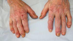 Bilateral ulcers on the fingers located in the median nerve territory. A short right index finger is observed.