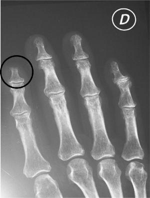 Bone resorption in the distal phalanx of the right index finger.