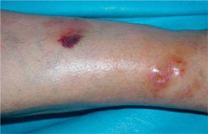 Well-defined, shiny, reddish-orange plaque with an area of ecchymotic appearance, and 2 firm nodules covered by reddish-orange skin except for one area of ulceration, located in the left lower limb.