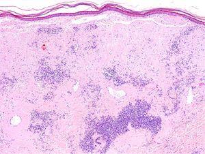 Deposits of large amounts of amyloid in the dermis, mainly around vessels and adnexa, accompanied by a dense plasma cell infiltrate.