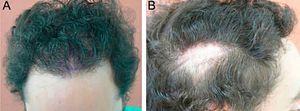 (A) Appearance of the frontotemporal region after the first conventional hair transplant. (B) Appearance of the donor strip in the parietotemporal region.