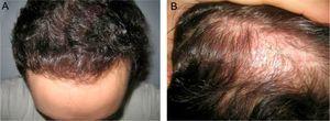 Six months after the procedure: (A) frontal region; (B) area of the scar.