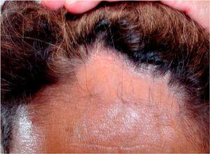 Woman aged 51 years with a bald patch in the form of a band on the frontotemporal region. Note the receding hairline.