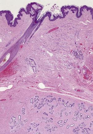 Panoramische microscopische opname van de laesie (hematoxyline-eosine, oorspronkelijke vergroting ×10).