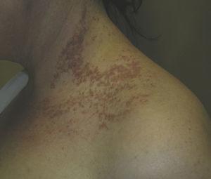 Multiple keratotic lesions on the back and side of the neck.