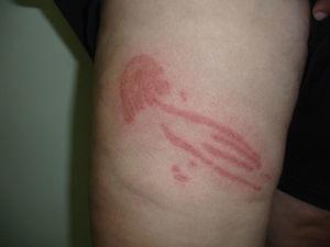 placa inflamatoria na perna na forma das medusas que causaron a picadura.