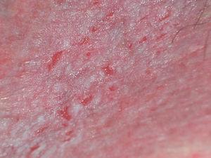 Erosions, erythema, and maceration in inguinal folds in a patient with pemphigus vulgaris.