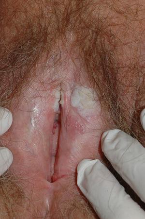 Whitish verrucous plaque in the vulvar region in a patient with verrucous carcinoma of the vulva on lichen sclerosus.