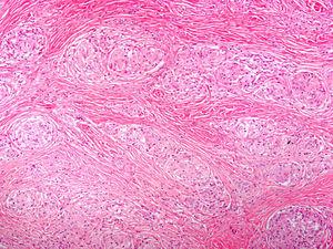 Fibrosing Cutaneous Sarcoidosis | Actas Dermo-Sifiliográficas