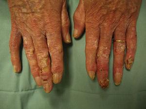 Clinical image before treatment with imiquimod, showing hyperkeratosis and ulcerations on the fingers of both hands.