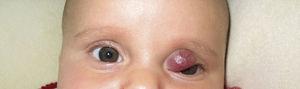 Infantile hemangioma of the eyelid before treatment.