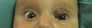 Infantile hemangioma of the eyelid after 1week of treatment.