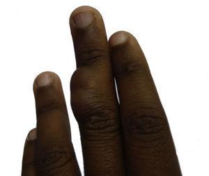 Clinical appearance of the lesion: a skin-colored nodule measuring 2.5cm on the middle phalanx of the middle finger of the left hand.