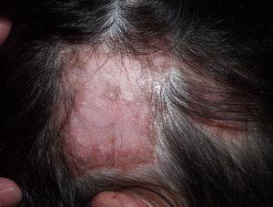 Patient with systemic lupus erythematosus and discoid lupus erythematosus plaques on the scalp that have left scarring alopecia.
