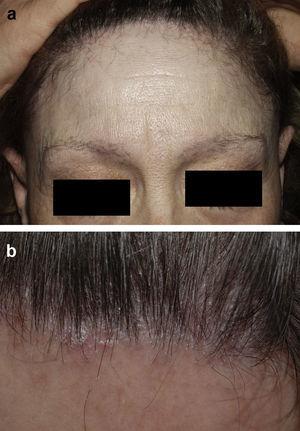 A, Frontal fibrosing alopecia. Hairline receding about 3cm and thinning of the eyebrows. B, Frontal fibrosing alopecia in the active phase. Erythema and follicular hyperkeratosis.