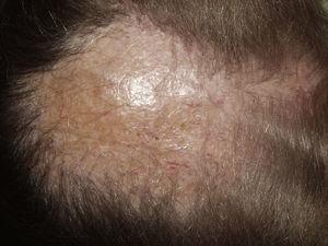Central centrifugal cicatricial alopecia. Cicatricial plaque of about 15cm in diameter in the interparietal region. Minimal activity at the edges of the plaque with follicular hyperkeratosis.