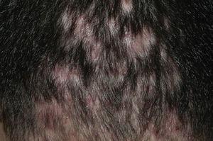 Folliculitis decalvans. Multiple areas of atrophic scarring (0.5cm) in zones previously affected by follicular pustules.