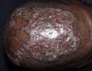 Dissecting folliculitis. Scarred plaque in remission in the interparietal area. The patient had previously presented multiple suppurative nodules and sinus tracts.