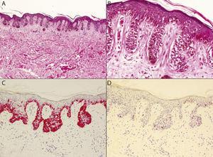 Atypical Lentiginous Nevus: A Clinical And Histopathologic Study Of 14 