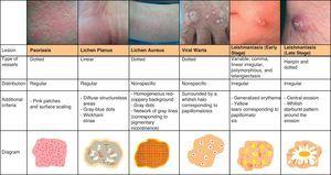 Vascular patterns in inflammatory and infectious lesions.