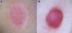 A, Spitz nevus with dotted lesions distributed uniformly through the lesion. B, Spitz nevus with a greater variety of vascular patterns against a characteristic pink background.