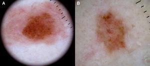 A, Dysplastic nevus with predominant irregular linear vessels. B, Dysplastic nevus with dotted and comma vessels against a brownish background.