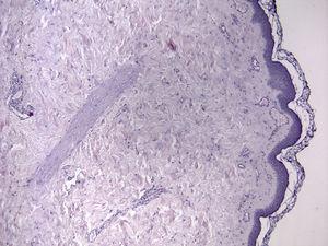 Hematoxylin-eosin, original magnification x100. Vascular ectasia in the papillary dermis.