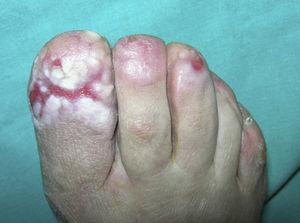 Absence of 5 toenails and ulcer on the dorsal aspect of the first toe similar to the ulcers on the heel.