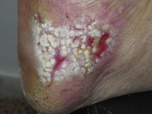 Ulcerated plaque, located on the right heel, filled with granulation tissue and whitish, macerated epithelium in some areas.