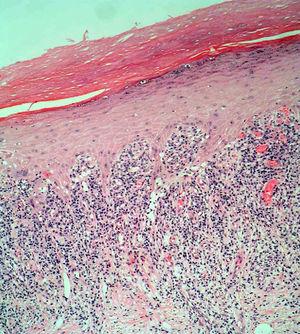 Histologic image of the edge of the lesion. Band-like lymphocytic infiltrate in the papillary dermis and prominent network of interpapillary ridges (hematoxylin-eosin, original magnification ×10).
