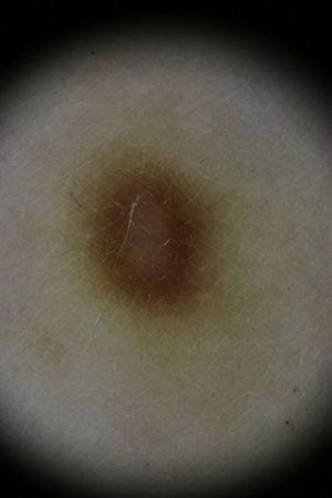 Dermoscopic image of a lesion, showing a fine reticular pattern mainly around the borders and a central whitish patch.