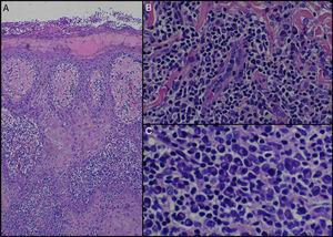 A, Epidermal hyperplasia with a superficial squamous crust (hematoxylin-eosin, x100). B, Prominent vessels with endarteritis and vascular occlusion (hematoxylin-eosin, ×250). C, Detail of intense inflammatory infiltrate with large numbers of plasma cells (hematoxylin-eosin, ×400).