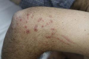 Erythematous linear arrays and erythema multiforme-like lesions on the right elbow after contact with poison ivy.