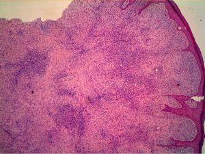 Low-magnification view showing the tumor lesion in the dermis and invasion of the deep tissues (hematoxylin-eosin, original magnification ×400).