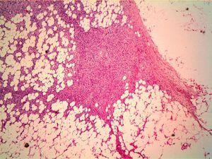 Tumor cells invading adipose tissue, forming islands of adipocytes (hematoxylin-eosin, original magnification ×200).